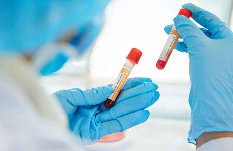 Bilirubine élevée : quand s'inquiéter ?